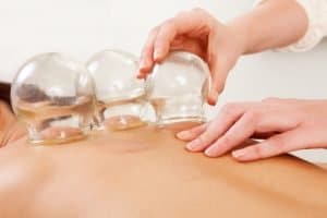 Cupping therapy Moonee Ponds