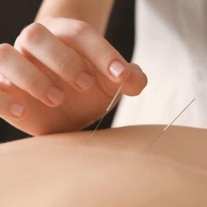 acupuncture for low back pain Melbourne